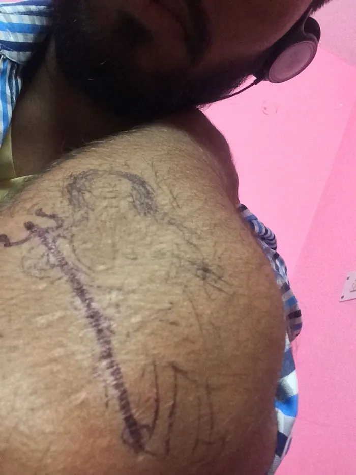 Tattoo covering a scar on a person’s arm to create a work of art.