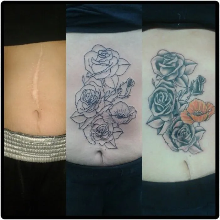 Tattoo transforming a scar into floral art on skin.