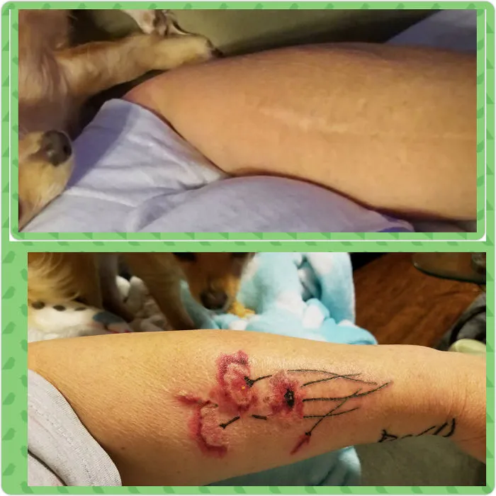 Scar turned into art with floral tattoo design on forearm, showcasing creativity in transforming scars with ink.
