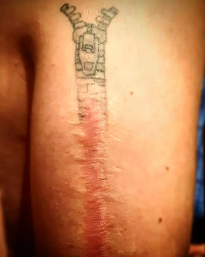 Tattoo art creatively covering a scar on an arm, transforming it into a piece of amazing artwork.