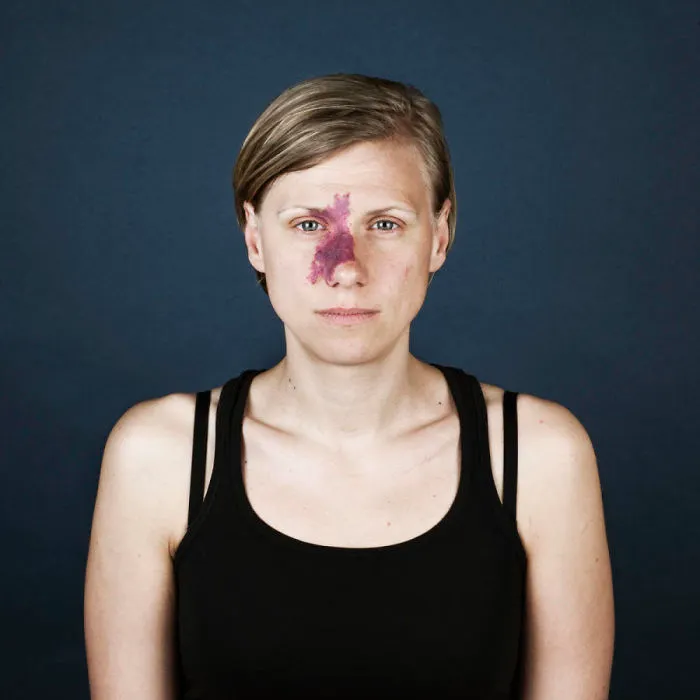 19 Portraits Of People With Birthmarks That Might Change The Way You See Them