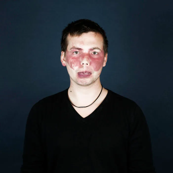 19 Portraits Of People With Birthmarks That Might Change The Way You See Them