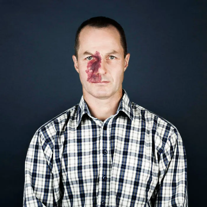 19 Portraits Of People With Birthmarks That Might Change The Way You See Them