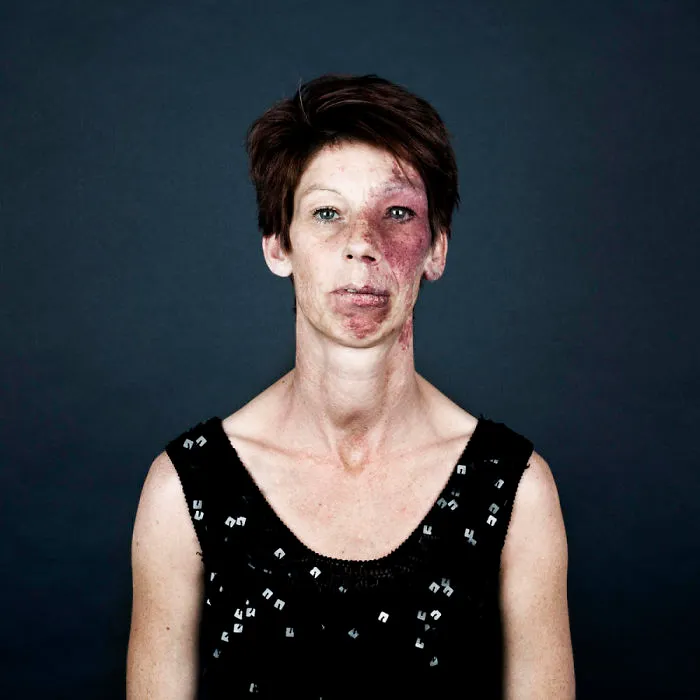 19 Portraits Of People With Birthmarks That Might Change The Way You See Them