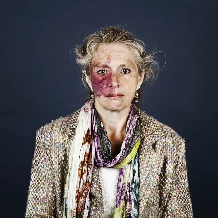 19 Portraits Of People With Birthmarks That Might Change The Way You See Them