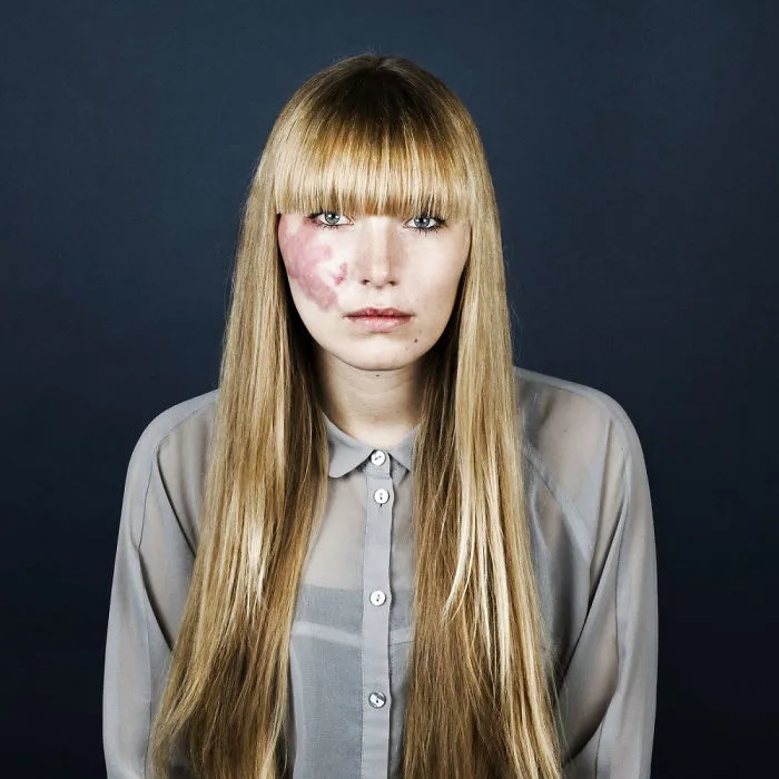 19 Portraits Of People With Birthmarks That Might Change The Way You See Them