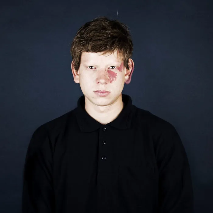 19 Portraits Of People With Birthmarks That Might Change The Way You See Them