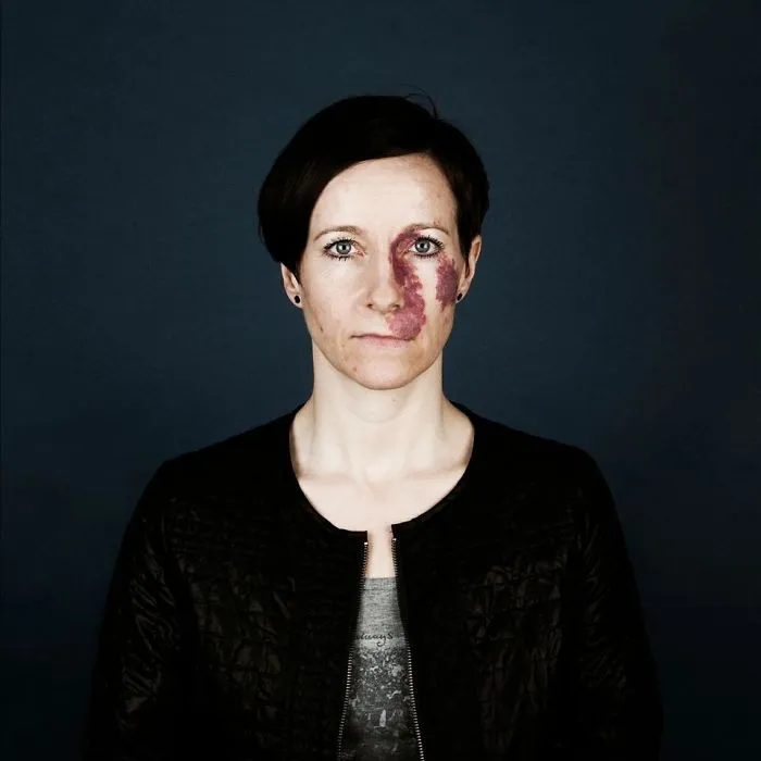 19 Portraits Of People With Birthmarks That Might Change The Way You See Them