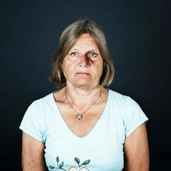 19 Portraits Of People With Birthmarks That Might Change The Way You See Them