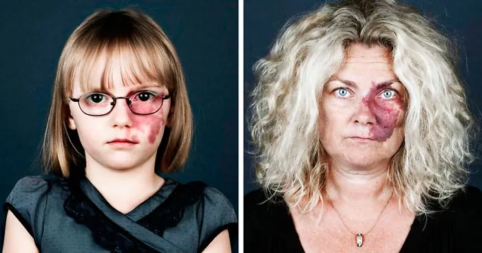 19 Portraits Of People With Birthmarks That Might Change The Way You See Them