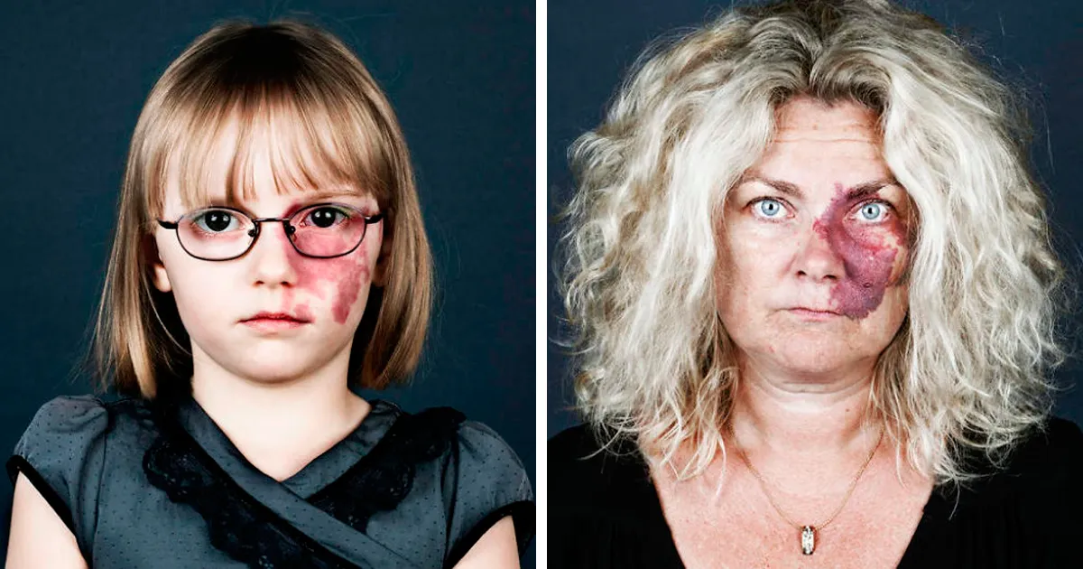 10+ Retratos de personas con marcas de nacimiento que quizá cambien tu forma de verlos