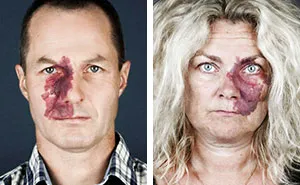 19 Portraits Of People With Birthmarks That Might Change The Way You See Them