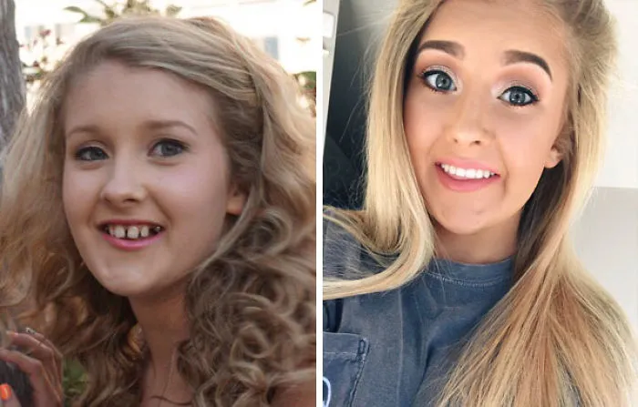After 8 Years Of Treatment, 10 Teeth Pulled, Surgery, & 2 Rounds Of Braces, I Finally Love My Smile