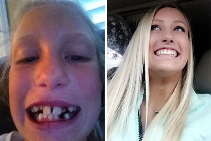 After 2 Sets Of 25 Months, 12 Teeth Pulled, & Wisdom Teeth Pulled, Im Finally Braces Free