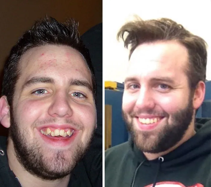 My Single Mother Couldn't Afford Braces For Us Growing Up. So When I Got A Job, I Saved And Paid For Them Myself. Most Fulfilling Decision I've Ever Made