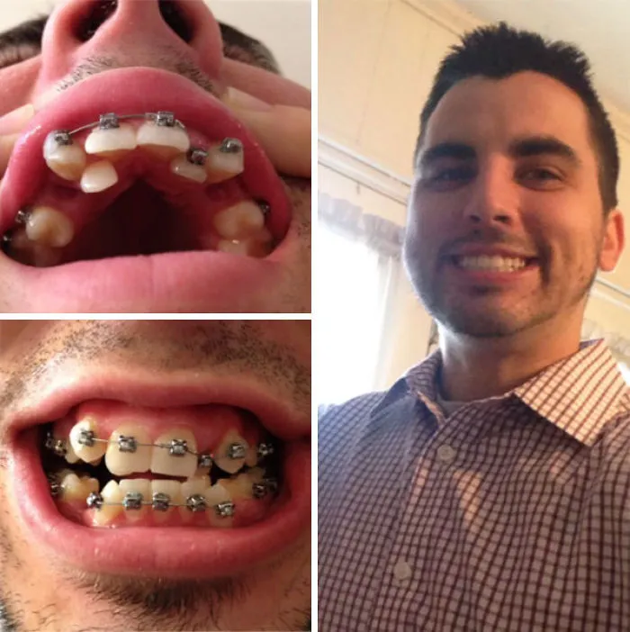 My Single Mother Couldn't Afford Braces For Me Growing Up. When I Got Insurance Though Work I Got Some Finally. Life Goal Complete