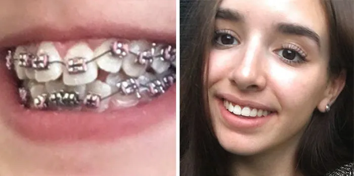 13 meses de aparato, expansor mecánico de mordida y 2 coronas