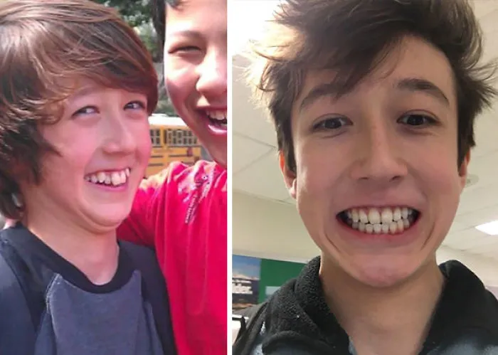 Before And After - 2 Years And 10 Months