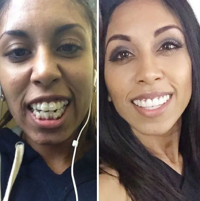 Showing Off The New Smile