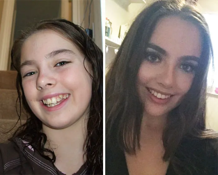 4 Years Difference Amen For Braces