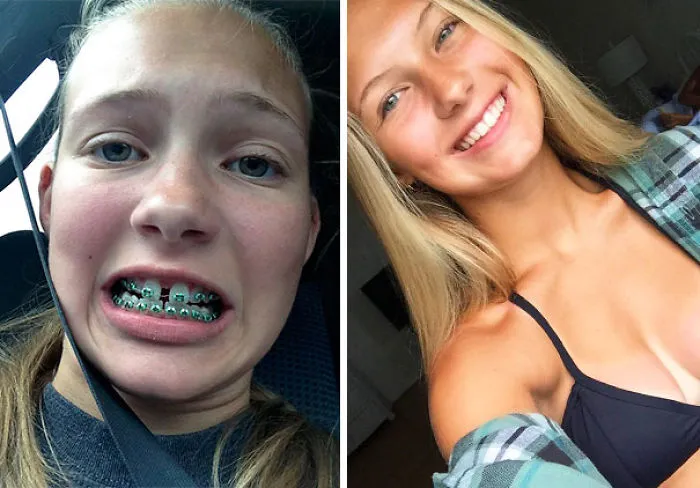 El aparato dental funciona