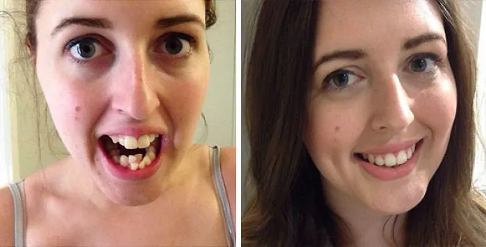 Got My Braces Off Yesterday, Here's Before, During And After