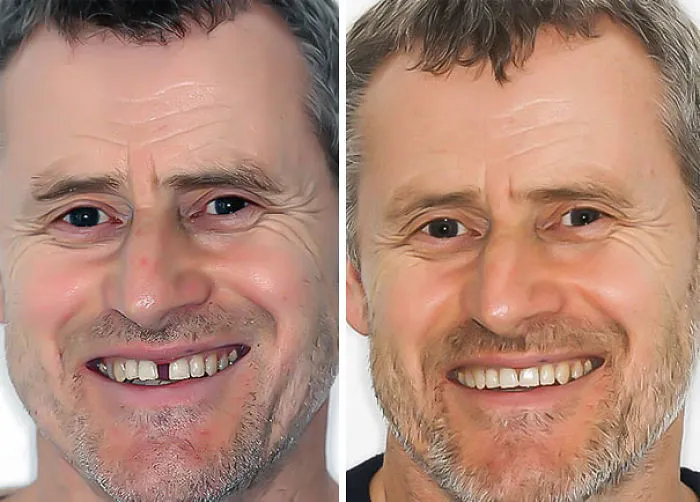 Antes y después