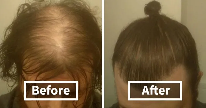 Men Are Hiding Baldness With Man Buns, But It's Riskier Than You Think
