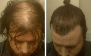 Men Are Hiding Baldness With Man Buns, But It's Riskier Than You Think