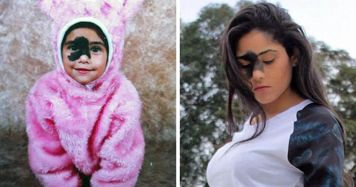 Esta chica eligió no quitarse su rara marca de nacimiento, y explica el porqué
