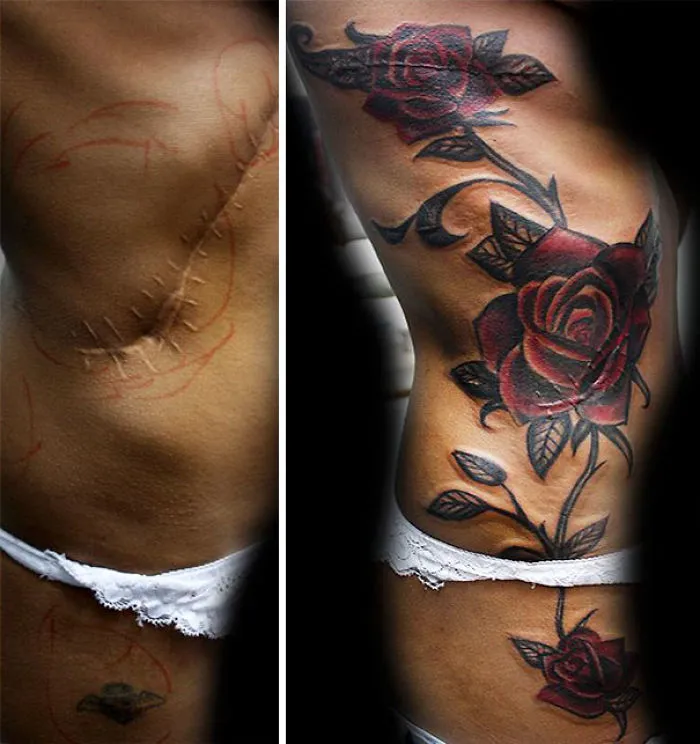Scar transformed with a rose tattoo, showcasing amazing tattoo art enhancing the body.