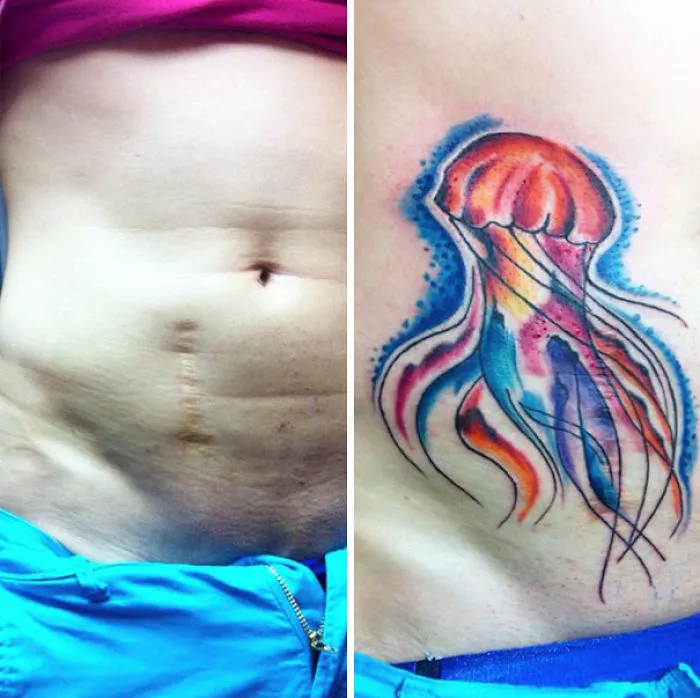 Colorful jellyfish tattoo transforms scar into art.