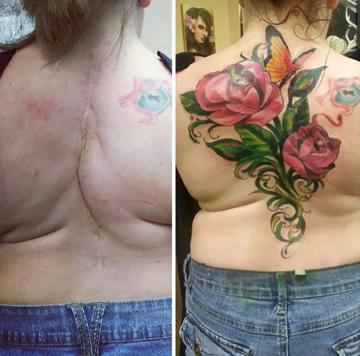 Scar covered by a floral tattoo design with a butterfly on the back, transforming it into art.