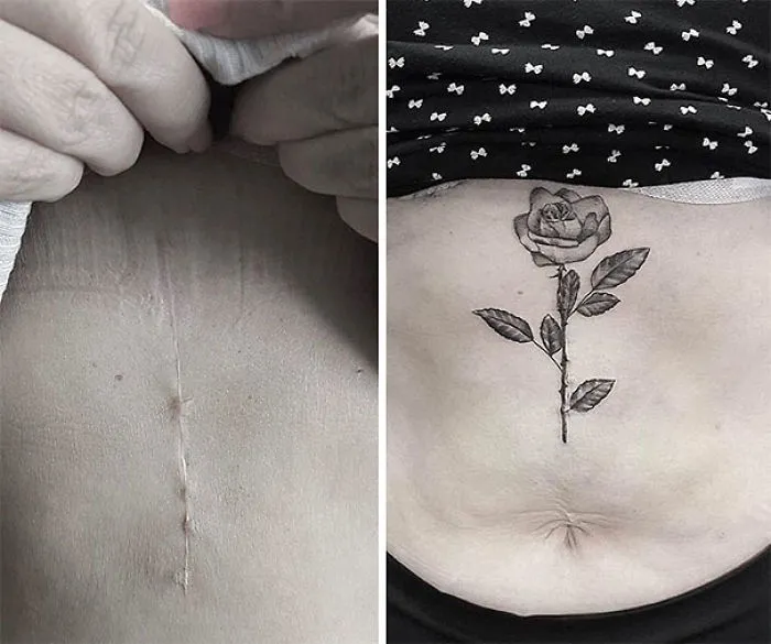 Tattoo transforming a scar into a rose artwork on skin.