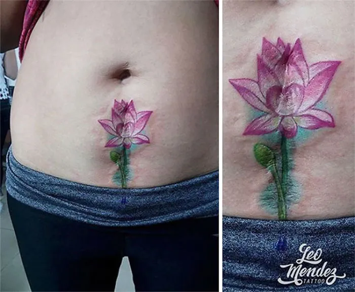 Tattoo transforms scar into a colorful lotus flower on abdomen, creating a beautiful work of art.
