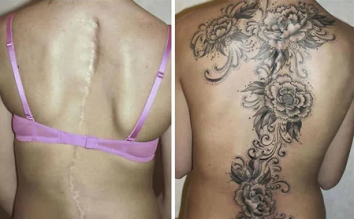 Tattoo transforms back scar into floral artwork.