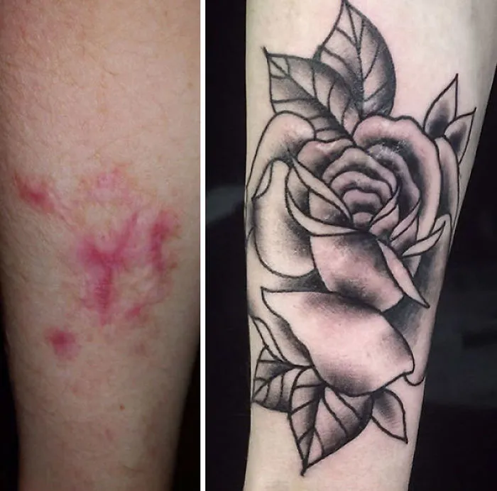 Scar covered by a rose tattoo, transforming it into a work of art.