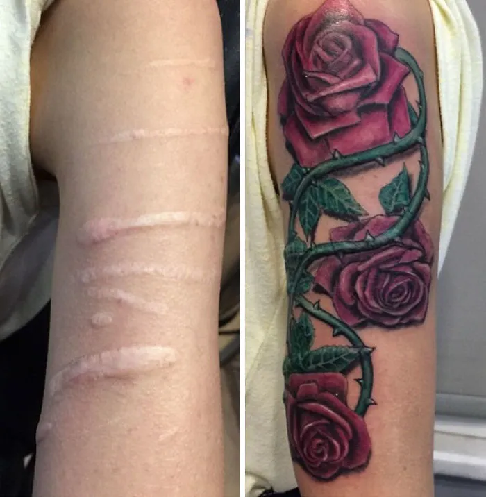 Scar covered with a vibrant rose tattoo, transforming it into art.