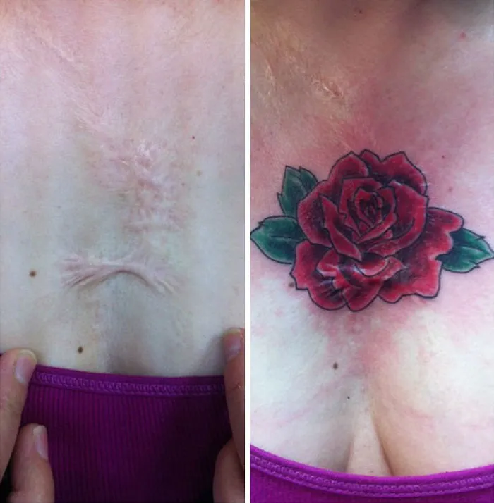 Scar transformed into art with a vibrant rose tattoo.