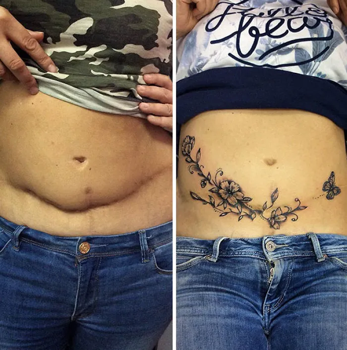 Before and after photo of amazing tattoos covering a scar, transforming it into a floral work of art.
