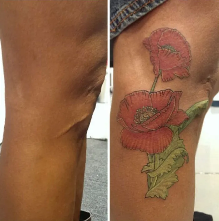 Tattoo transforms scar into artwork with vibrant red flowers on a leg.