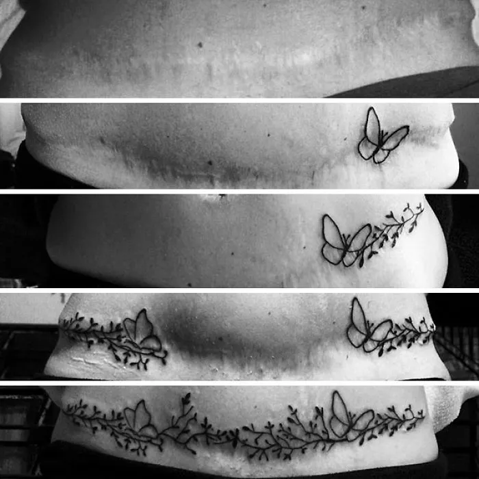 Tattoos transform a scar into butterfly art across four stages.