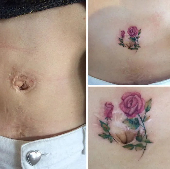 Tattoo turns belly scar into floral art with pink roses and green leaves, creating stunning body transformation.