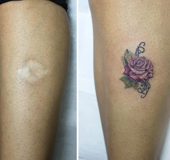 Tattoo transforms a scar into a rose artwork on skin.
