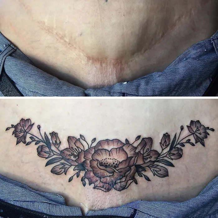 Floral tattoo transforms a scar into art on lower abdomen.