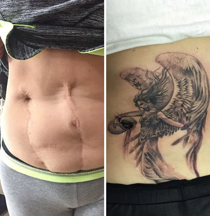 Scar transformed with an angel tattoo, turning it into an amazing work of art.