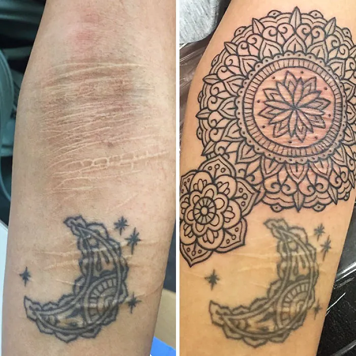 Tattoos creatively transforming scars with an intricate mandala design.