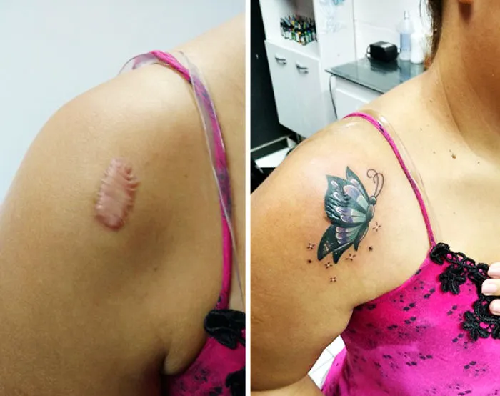 Butterfly tattoo transforms shoulder scar into art, showcasing innovative tattoo designs.