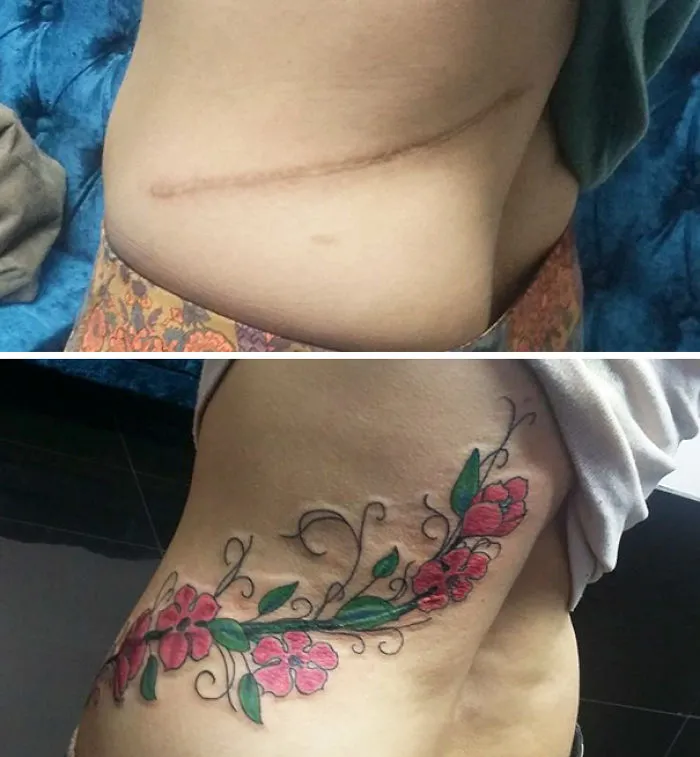 Scar transformed into art with a floral tattoo on the side of a torso.