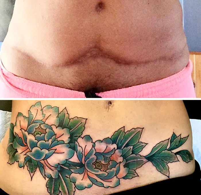 Floral tattoo transforming an abdominal scar into colorful art.